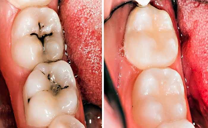 bị sâu răng có nên bọc sứ không