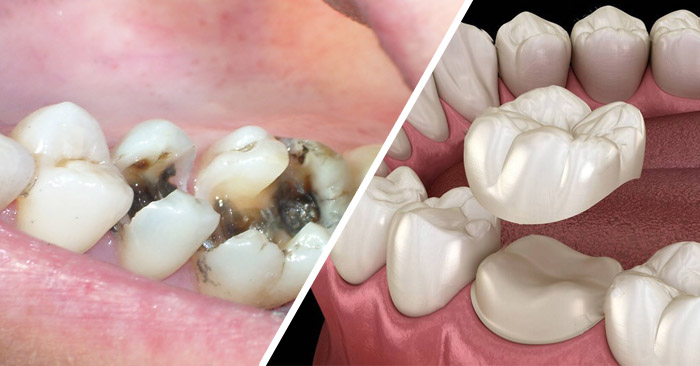 Răng khấp khểnh có bọc sứ được không