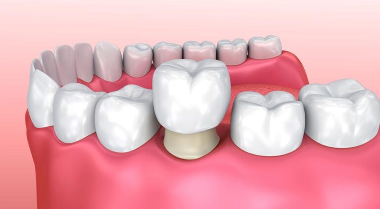 Những lưu ý trước khi bọc răng sứ