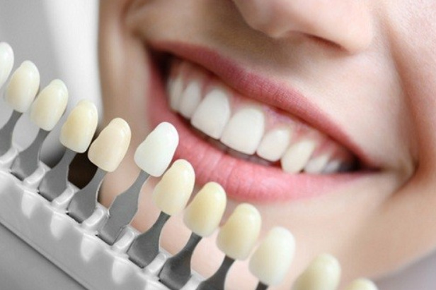 Bọc răng sứ màu nào tự nhiên